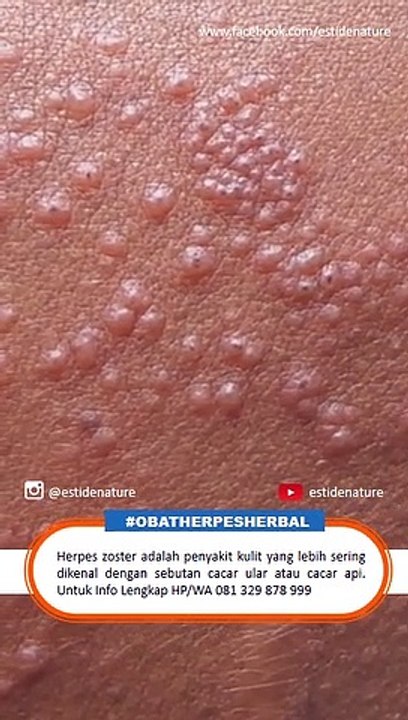 Herpes Dapat Menular Dengan Mudah - Ini Dia Cara Mengobati Herpes Sampai Sembuh Total