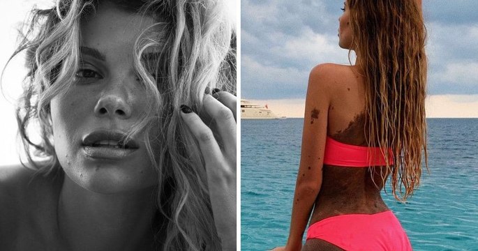 Née avec une tâche couvrant la moitié de son corps, elle décide d’assumer