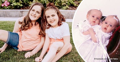 Reliées par la hanche à la naissance, 14 ans plus tard ces siamoises ont bien changé