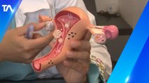 98 % de casos de cáncer de cuello uterino son causados por el virus del papiloma humano