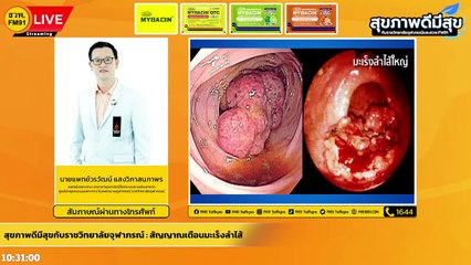สัญญาณเตือนมะเร็งลำไส้ : สุขภาพดีมีสุขกับราชวิทยาลัยจุฬาภรณ์และสวพ.FM91 : 25 มี.ค. 65