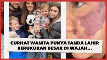 Punya Tanda Lahir Berukuran Besar di Wajah, Curhat Wanita Soal Penampilannya di Depan Tunangan