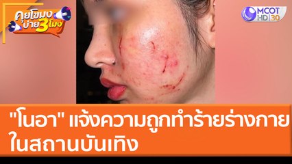 "โนอา" แจ้งความถูกทำร้ายร่างกายในสถานบันเทิง (28 มี.ค. 65) คุยโขมงบ่าย 3 โมง