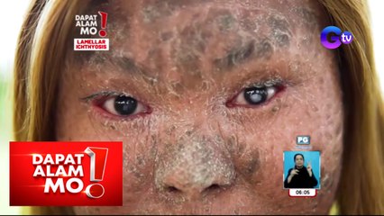 Dapat Alam Mo!: Babae, halos magbitak-bitak ang balat sa buong katawan!