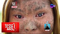 Dapat Alam Mo!: Babae, halos magbitak-bitak ang balat sa buong katawan!