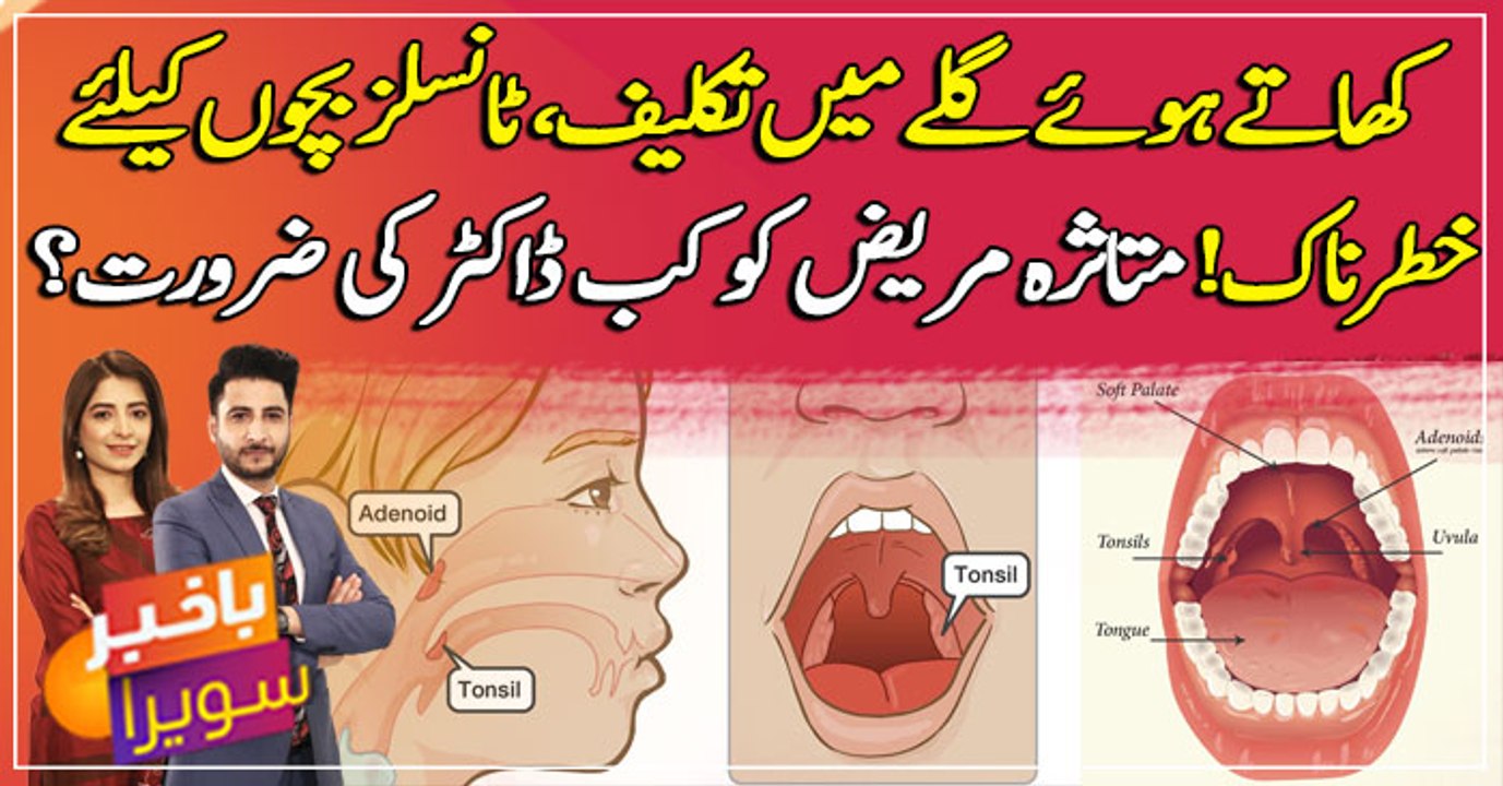 What are Tonsil Stones? Causes, symptoms and treatments