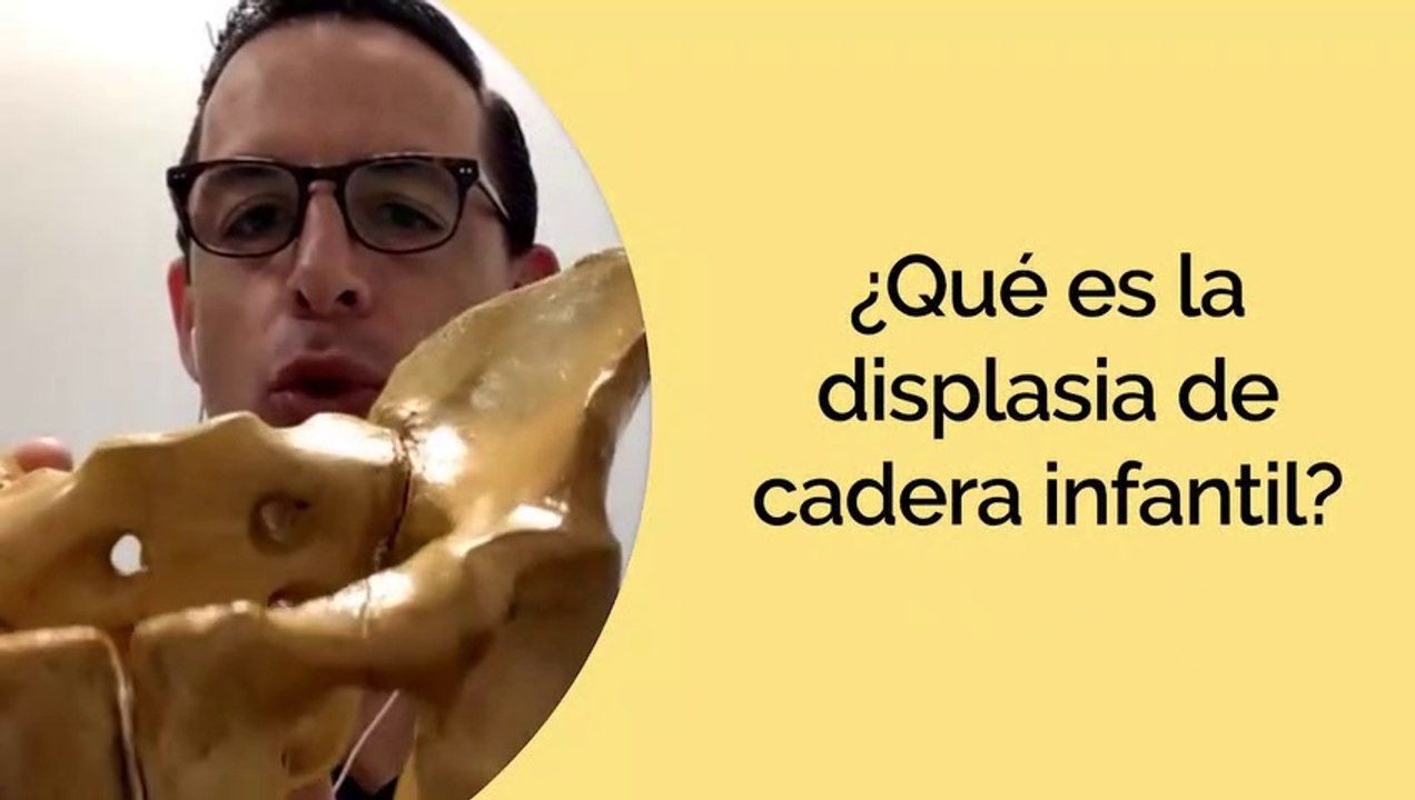 La DISPLASIA de CADERA INFANTIL - Carlos A. Vidal, Ortopedista Pediatra