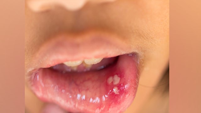 मुंह में बार-बार छाले होना है शरीर में इन गंभीर समस्याओं का संकेत,जानिए कारण और उपाय । Boldsky