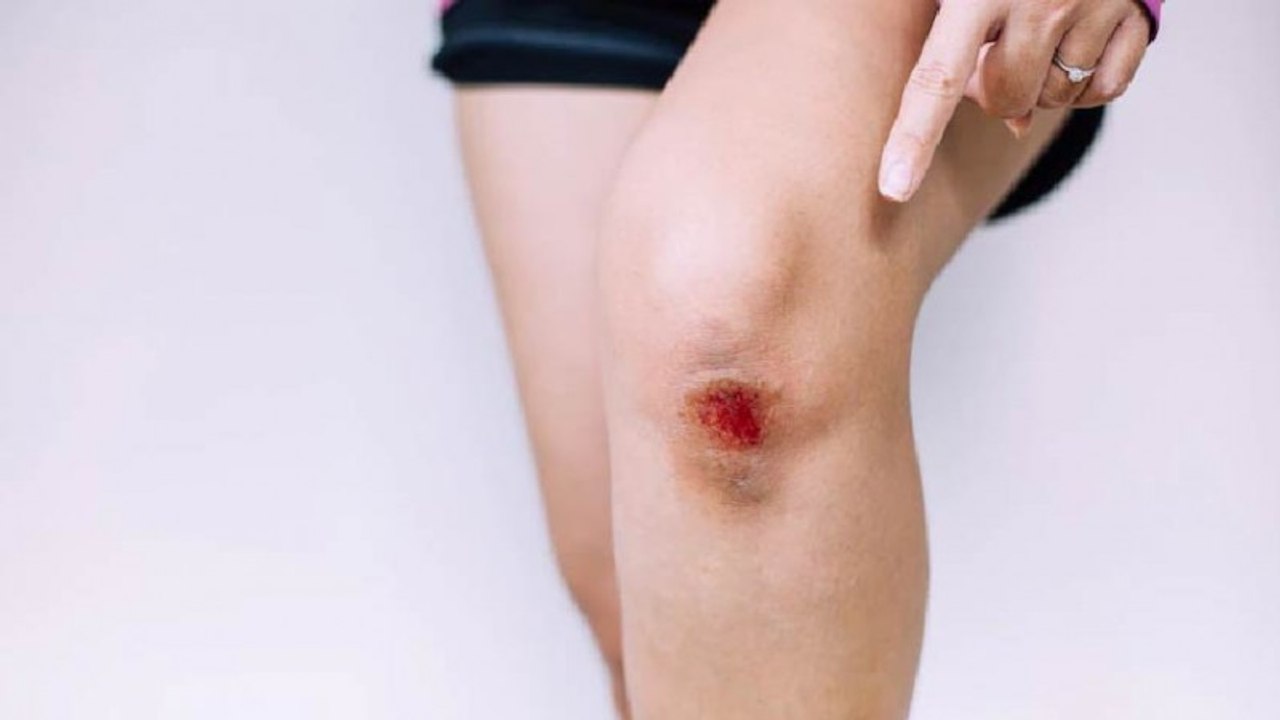 Bekas Luka di Kaki Bikin Minder? Pudarkan dengan Ini