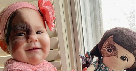 Une maman veut montrer que sa fille est belle malgré sa tache de naissance sur le visage
