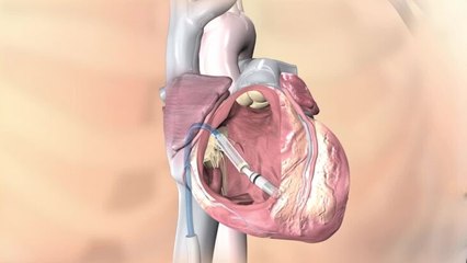 Teeny tiny pacemaker