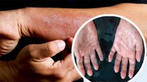 हाथ में खुजली होना Dermatitis से लेकर Dyshidrotic Eczema Symptoms, क्या है कारण | Boldsky