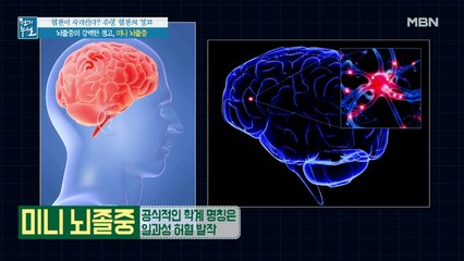 뇌졸중의 강력한 경고! 유령 혈관이 부르는 미니 뇌졸중