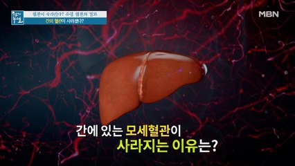 간의 혈관이 사라진다? 간 경화 부르는 유령 혈관