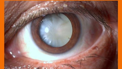 bd-aclaramos-dudas-y-mitos-sobre-las-cataratas-010422