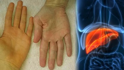 हथेली पीली क्यों होती है | हथेली पीली होने का कारण | Boldsky