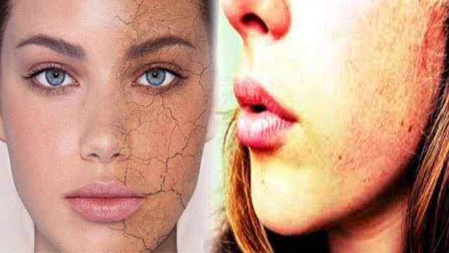 गर्मियों में ड्राई स्किन ध्यान रखने का सही तरीका । गर्मियों में ड्राई स्किन का कैसे करें केयर ।