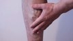 Varicose veins: Does crossing your legs lead to this condition?