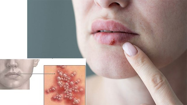 Lips किनारों में जलन सूजन होना है गंभीर बीमारी । जानिए कारण, लक्षण और उपाय । Boldsky