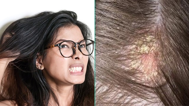 गर्मियों में सिर में दाने खुजली होना खतरनाक जानिए कारण और उपाय । सिर में इन्फेक्शन क्यों होता है