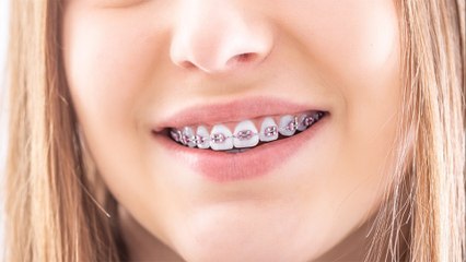 bd-mitos-y-verdades-de-la-ortodoncia-050422