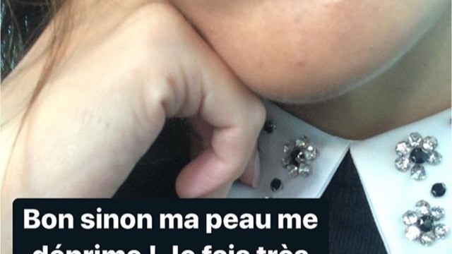 VOICI-PHOTO Iris Mittenaere montre ses boutons au visage, elle reçoit le soutien de ses fans
