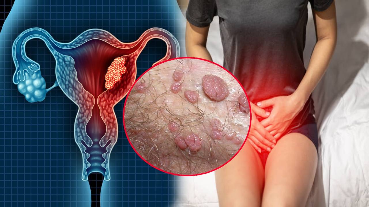 Private Part में मस्से होना Genital Warts Symptoms, क्या है कारण |Boldsky