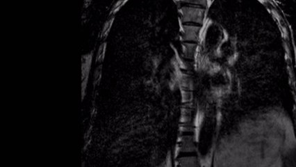 Microplastics Found in the Lungs of Living People for the First Time