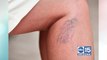 Vein Envy offers the most advanced, minimally invasive techniques to treat vein disease