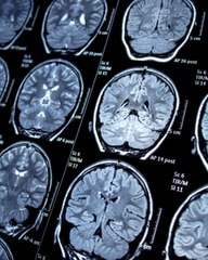 CAM - Quelle est la différence entre un scanner et une IRM ?