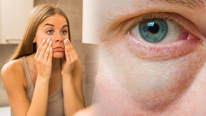 सुबह उठने पर Eye Swelling क्यों होती है | आंखो में सूजन के कारण | Boldsky