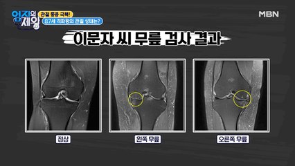87세 격파왕의 충격적인 관절 상태 공개!