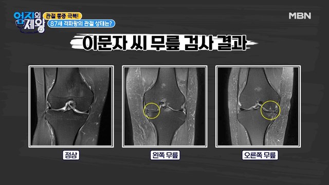 87세 격파왕의 충격적인 관절 상태 공개!