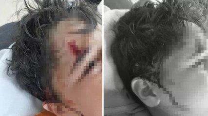 Bursa'da okul yolunda 8 köpek saldırdı! Vücuduna 80 dikiş atıldı