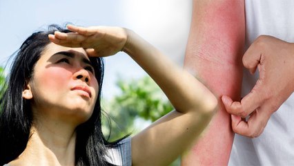 Sunlight में Body Itching क्यों होती है | धूप में खुजली होने का कारण Watch Video |Boldsky