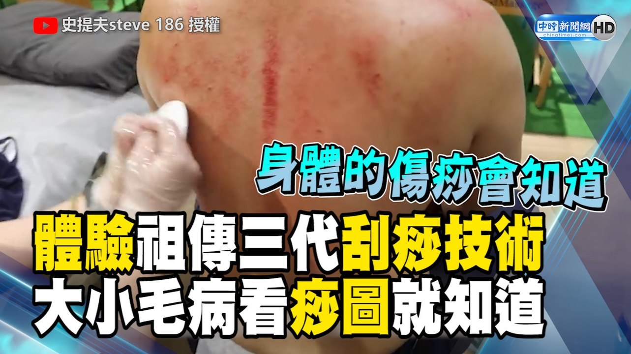 體驗祖傳三代刮痧技術 大小毛病看痧圖就知道