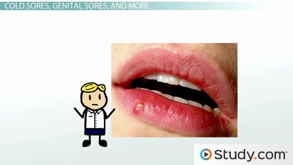 Understanding Chickenpox, Herpes, and Mono: Diseases Caused by Herpesviridae 🦠 - thumbnail