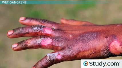 Gangrene- Signs & Treatment -