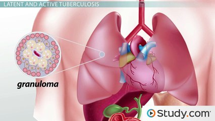 Tuberculosis- Diagnosis, Treatments & Latency