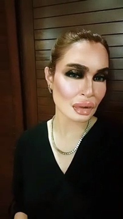 Nadia Hussain Lip Fillers Goes wrong Public Response