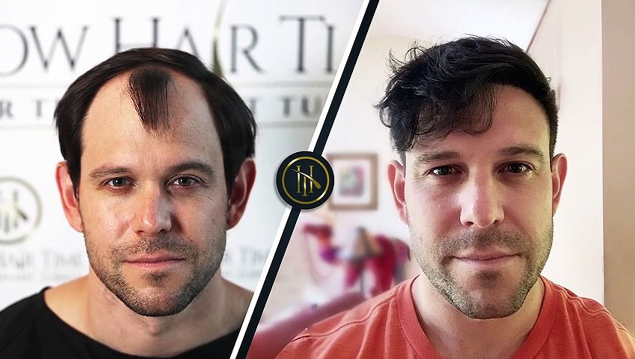 Hair Transplant Before and After | Hair Transplant Results