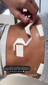 Aurélie Dotremont dévoile ses pansements après son opération