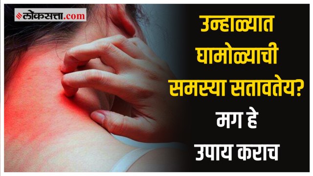 उन्हाळ्यात घामोळ्याच्या त्रासापासून सुटका करायची असेल तर करा हे घरगुती उपाय