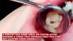 Tiktok dentist claims cavities are contagious - is it true?