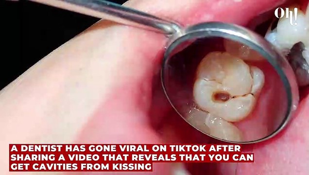Tiktok dentist claims cavities are contagious - is it true?