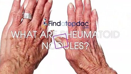 FindaTopDoc - What Are Rheumatoid Nodules?