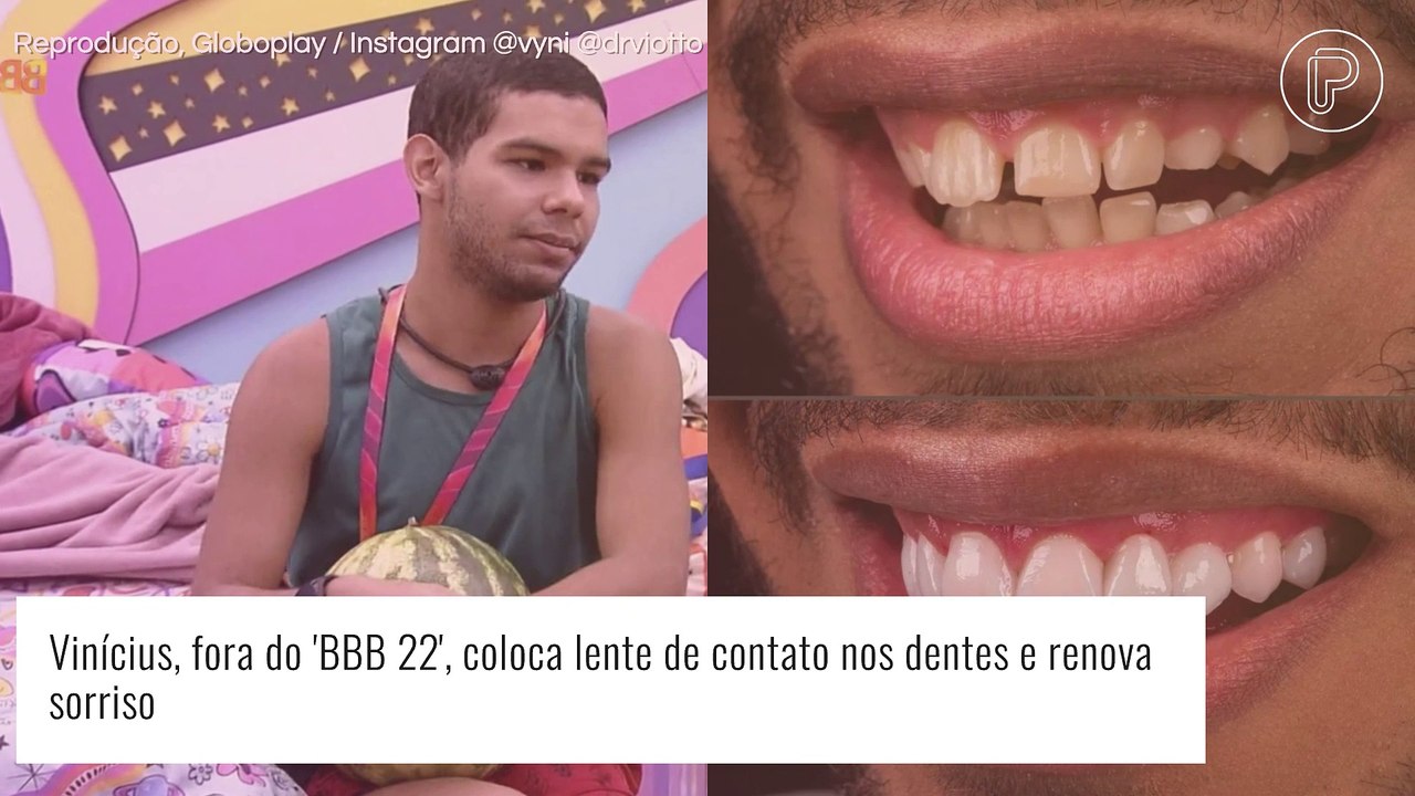 Fora do 'BBB 22', Vinícius e Lucas surpreendem ao colocar lente de contato nos dentes. Veja antes e depois!