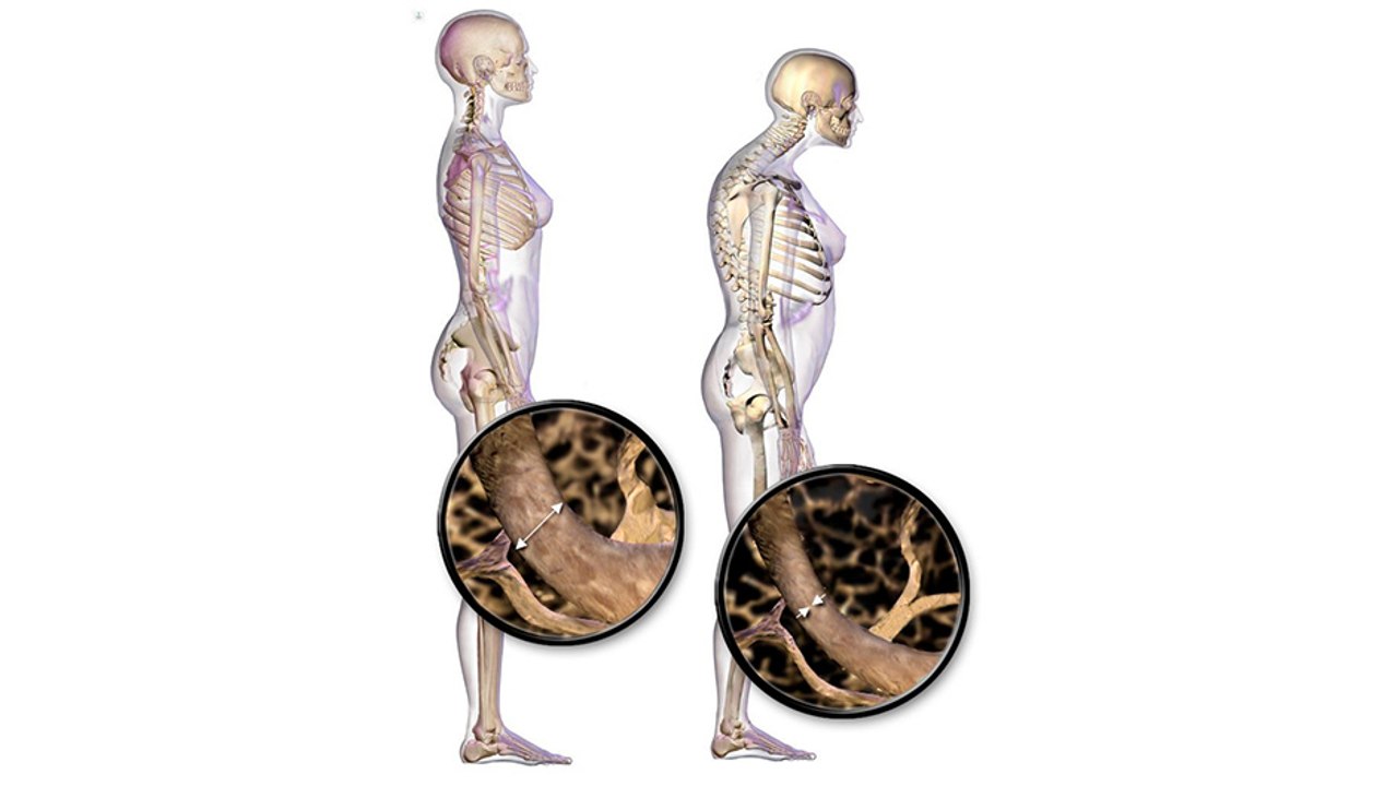 bd-Osteoporosis en hombres: sus causas, síntomas y tratamientos-220422