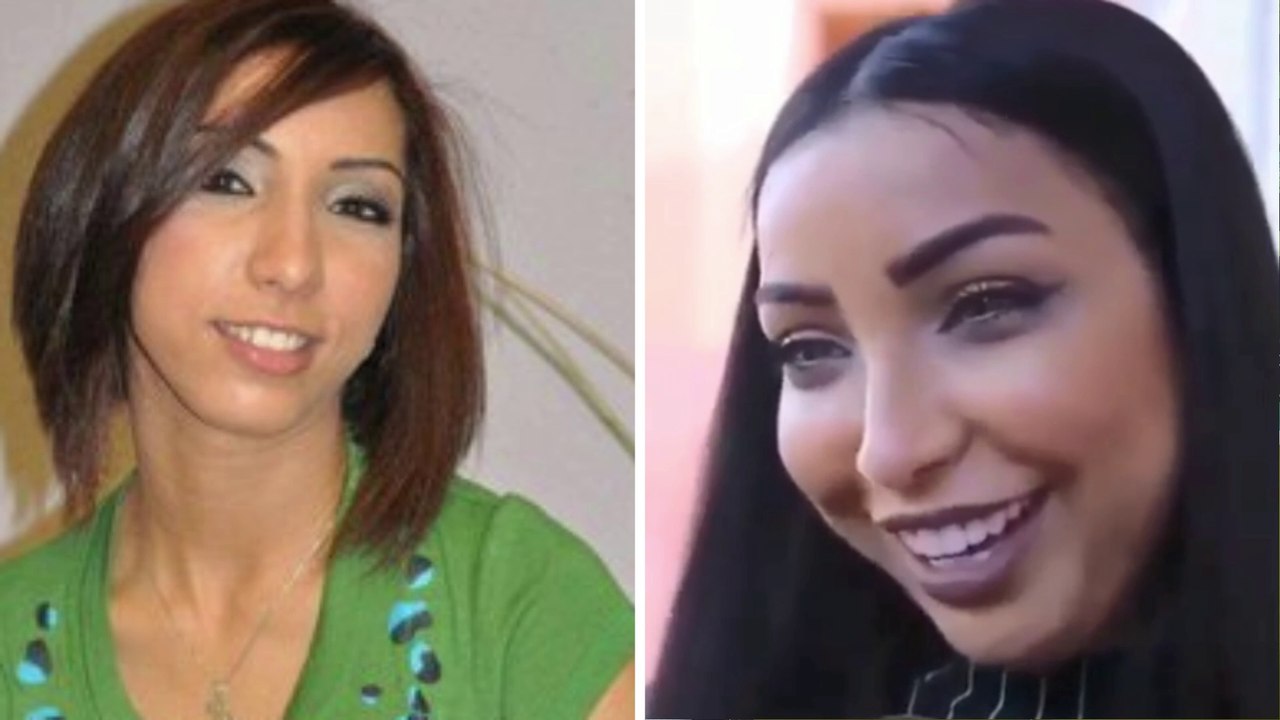 الصقر : مشاهير قبل و بعد عملية تجميل الانف , نتائج صادمة و كوارث