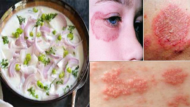 प्याज और दही साथ खाने से क्या होता है । प्याज और दही साथ खाने के नुकसान । Boldsky